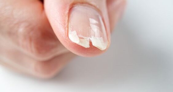 Cabeza Sensible moverse Cómo fortalecer las uñas quebradizas y escamadas - Beauty Nails